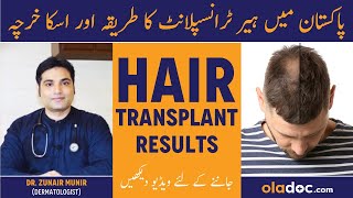 Hair Transplant Results  Cost Of Hair Transplant In Pakistan  Girte Baal Aur Ganjpan Ka Khatma [upl. by Enneyehs703]