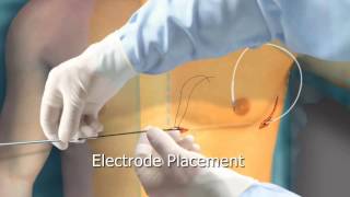 Subcutaneous ICD Animation  Arrhythmiaorg [upl. by Lydnek]