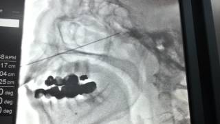 Nevralgie trijumeau Electrocoagulation [upl. by Essined]