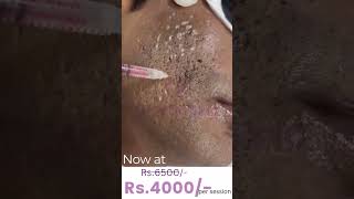 Acne scar Treatment TCA CROSS flawlessskin KrystalskinclinicHyderabad [upl. by Cleo]