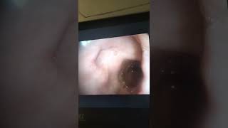 Endoscopy Duodenal quot Bulbarquot Ulcer [upl. by Brott]