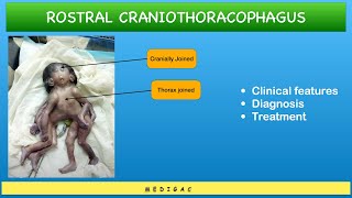 Conjoined Twins  Craniothoracophagus  Clinical features  Diagnosis  Treatment [upl. by Tommy]