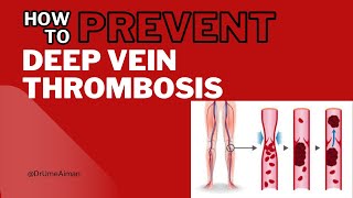 Deep Vein Thrombosis  How to prevent DVT [upl. by Einnel618]