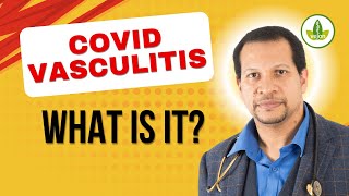 IS Covid Vasculitis a Silent KILLER [upl. by Rashida]