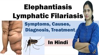 Elephantiasis  Filariasis  Symptoms Causes Diagnosis Treatment Prevention  In Hindi [upl. by Holli]