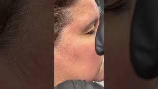 Treating Sebaceous Hyperplasia [upl. by Saddler888]