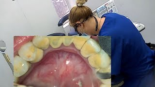 Dental visit  Teeth cleaning  Scaling [upl. by Plumbo]