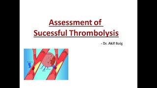 Assessment of successful thrombolysis in STEMI  Dr Akif Baig [upl. by Eiryk625]