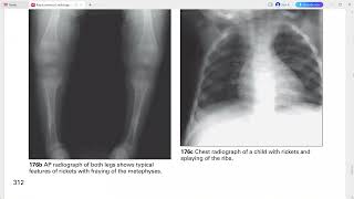 PEDIATRIC RADIOLOGY EXAM CASES SH [upl. by Faina]