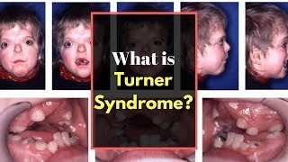 Turner syndrome Symptoms  Causes Pictures Signs and Symptoms of Turners syndrome [upl. by Losiram]