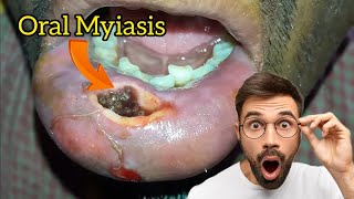 Oral myiasis disease symptoms treatment lifecycle [upl. by Ennahtebazile]