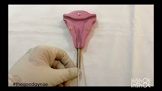 Copper T 380 A insertion and removal  Cu T n IUCD Insertion IUD Interval copperT OSCE USMLE [upl. by Favin58]