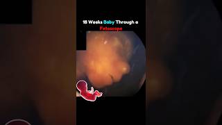 18 Weeks Baby Through Fetoscope 🤩💕 pregnancy fetus [upl. by Lustick]