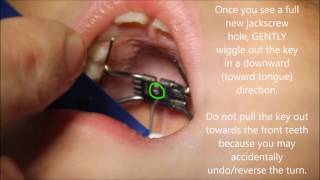 How To Turn a Rapid Palatal Expander [upl. by Chastain]