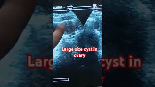 Largest cyst in ovaryshortyoutubevideo pregancyultrasound pregnant [upl. by Iveksarap]