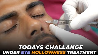 Under Eye Hollowness Treatment  Awish Clinic  Under Eye Filler  undereyedarkcircle viral [upl. by Ytineres]