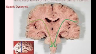 Spastic dysarthria  samples and tutorial [upl. by Eux]