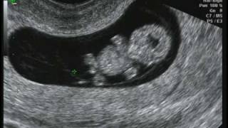 9 weeks 2 days Ultrasound [upl. by Aciretehs724]