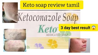 keto soap tamil review  ketoconazole soap 3day best result 😍😱 [upl. by Lednar]