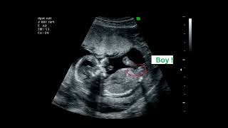 15 weeks active fetus  Its a Boy  By CRL  Ultrasound Case [upl. by Doley]