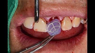 Immediate Implant Placement amp Minimally Invasive Horizontal Ridge Augmentation  Part 1 [upl. by Hugh]