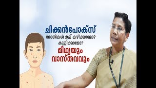 ചിക്കൻപോക്സ് മിഥ്യയും വാസ്തവവും  Chicken Pox [upl. by Carmela]