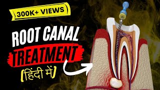 Root canal treatment in Hindi [upl. by Trilley363]