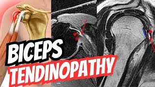 Biceps Tendinopathy Presentation  Orthopaedics High Yield Topics 10 [upl. by Lyrahc]