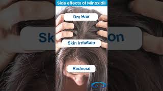 ❇️ Minoxidil for Hair Loss  Side  Effects of Minoxidil ❇️ Benefits of using Derma Roller shorts [upl. by Sergio]