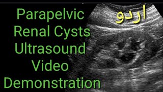 Parapelvic renal cyst ultrasound VIDEO demonstration [upl. by Rosati]