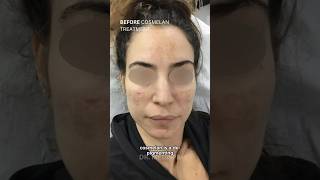 DePigmentation Peel Before amp After  Dr MediSpa [upl. by Neiviv100]