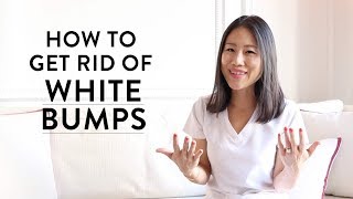 How to Get Rid of the White Bumps on Your Face  Peach amp Lily [upl. by Ixela540]