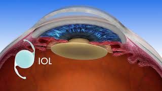 Florida Eye  LENSAR Laser Assisted Cataract Surgery [upl. by Warrick]