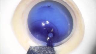 Novel Liquid Bubble dissection technique for DMEK lenticule preparation [upl. by Schild102]