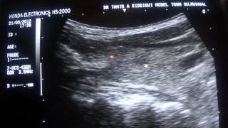 ultrasound  PARATHYROID GLAND [upl. by Okim]