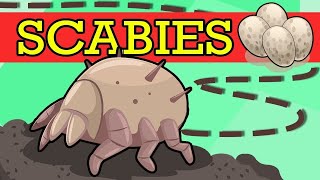 SCABIES Causes Signs and Symptoms Diagnosis and Treatment [upl. by Garibull]