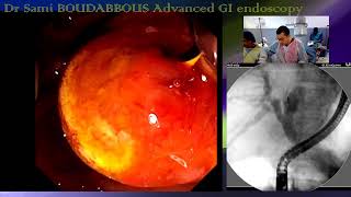 ERCP for advanced GB neoplasia [upl. by Jovia899]