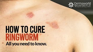 Type of Ringworm  How to cure Ringworm  All you need to know about Ringworms  Dr Rohit Batra [upl. by Asena]