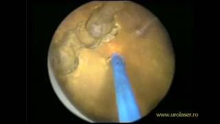 Laser lithotripsy of a bladder stone following HoLEP [upl. by Ragnar287]