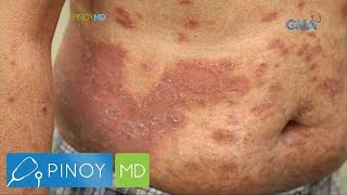 Pinoy MD Ano nga ba ang Psoriasis [upl. by Adnilreb]