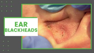 Ear Blackheads  Dr Derm [upl. by Anirat453]