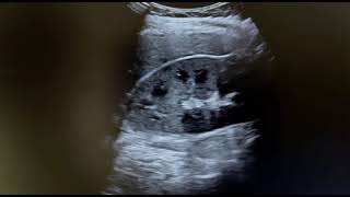 Ultrasound of acute pyelonephritis Read in description section n commrnt for detail history [upl. by Adnoel]