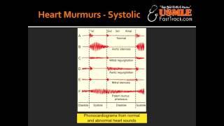 Heart Murmurs  Aortic Stenosis [upl. by Lemor594]