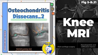 Fig 5B21 Radiographic Findings of Osteochondritis Dissecans [upl. by Riem]