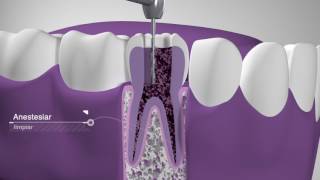 Endodoncia Dentimex [upl. by Pears]