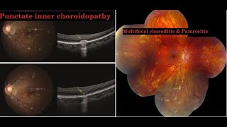 Punctate inner choroidopathy PIC amp Multifocal choroiditis and panuveitis MFC KanskiSeries 2022 [upl. by Annalise]