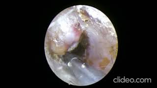 EAR CLEANING IN PATIENT HAVING EXOSTOSIS OF EAR [upl. by Hachmin237]