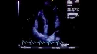 Echocardiography of the heart [upl. by Drucy]