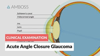 Acute Angle Closure Glaucoma [upl. by Novahs]