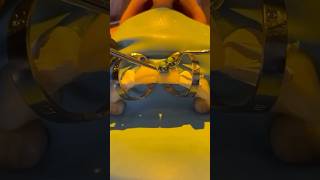 The cementation process for two porcelain veneers veneers veneers cosmeticdentistry [upl. by Byrd]